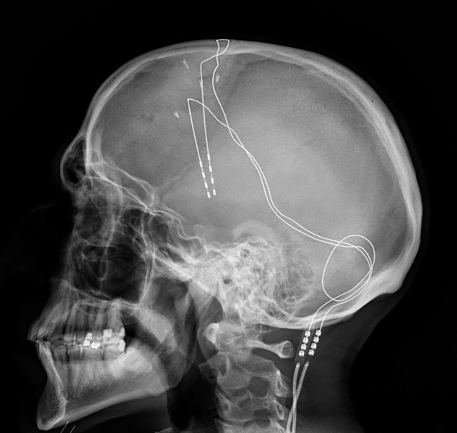 Scientists Develop Electrode-Based ‘Mood Decoder’ That Treats Depression