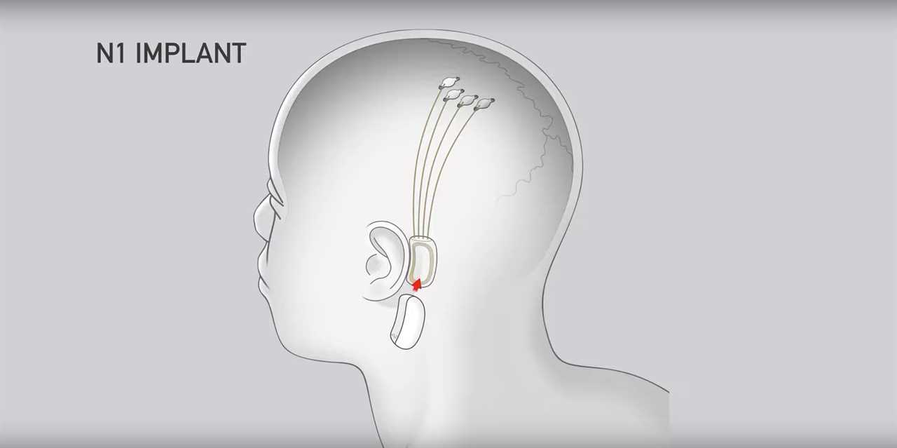 Neuralink chip