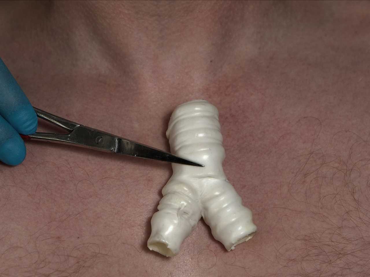 A plastic trachea, laid on top of a patient's chest with a pair of scissors holding it down.