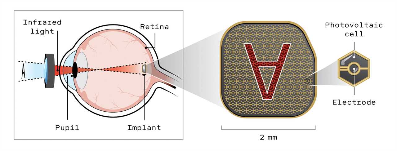 This implant can restore sight for patients with macular degeneration