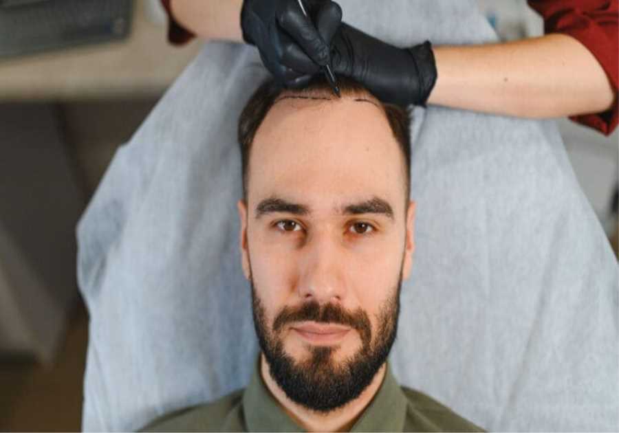 Top 10 Best Hair Transplant in Turkey